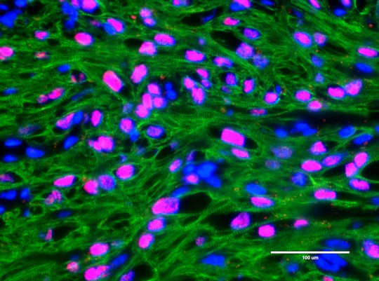 New human heart muscle forms in pig heart following CPC delivery
Following a myocardial infarction, catheter delivered CPCs differentiate to form new heart muscle cells in pig heart (green, cTnT, a heart muscle protein, red: human nuclear antigen; blue, DAPI, nucleus).